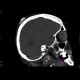 Fibroma, subcutaneous: CT - Computed tomography