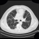 Lung fibrosis, decompensation after lobectomy: CT - Computed tomography