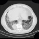 Lung fibrosis, decompensation after lobectomy: CT - Computed tomography