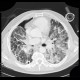 Lung fibrosis, decompensation after lobectomy: CT - Computed tomography