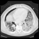 Lung fibrosis, decompensation after lobectomy: CT - Computed tomography