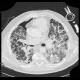Lung fibrosis, decompensation after lobectomy: CT - Computed tomography