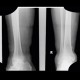 Periostosis, fibula, CVI, chronic venous insufficiency, perimalleolar edema: X-ray - Plain radiograph