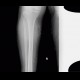 Periostosis, fibula, CVI, chronic venous insufficiency, perimalleolar edema: X-ray - Plain radiograph
