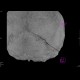 Fissure of skull, pneumocephalus, contusion: CT - Computed tomography
