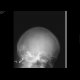 Fissure of the skull, pneumocephalus: X-ray - Plain radiograph