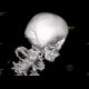 Fissure of the skull, pneumocephalus: CT - Computed tomography