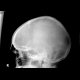 Fissure of the skull and epidural hematoma: X-ray - Plain radiograph