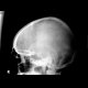 Fissure of the skull: X-ray - Plain radiograph