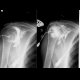 Fistulography of right shoulder: X-ray - Plain radiograph