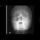 Fracture of the left zygomatico-maxillary complex: X-ray - Plain radiograph