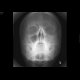 Fracture of the left zygomatico-maxillary complex: X-ray - Plain radiograph