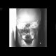 Fracture of the left zygomatico-maxillary complex: X-ray - Plain radiograph