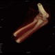 Fracture of capitulum humeri, VRT: CT - Computed tomography