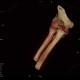 Fracture of capitulum humeri, VRT: CT - Computed tomography