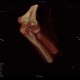 Fracture of capitulum humeri, VRT: CT - Computed tomography