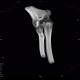 Fracture of capitulum humeri, VRT: CT - Computed tomography