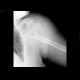 Fracture of neck of humerus: X-ray - Plain radiograph