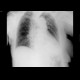 Fracture of neck of humerus: X-ray - Plain radiograph