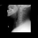Fracture of the mandible: X-ray - Plain radiograph
