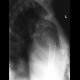 Fracture of colum chirurgicum of humerus: X-ray - Plain radiograph