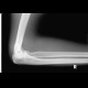 Fracture of capitulum radii: X-ray - Plain radiograph
