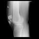 Fracture of patella: X-ray - Plain radiograph