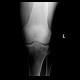 Fracture of patella: X-ray - Plain radiograph