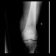Fracture of patella: X-ray - Plain radiograph