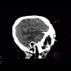 Stroke, cerebral ischemia, acute stage, MCA, medial cerebral artery: CT - Computed tomography