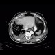 Gangrene of the liver: CT - Computed tomography