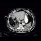 Gangrene of the liver: CT - Computed tomography