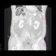 Gangrene of the liver: CT - Computed tomography