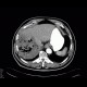 Gangrene of the liver: CT - Computed tomography
