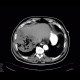 Gangrene of the liver: CT - Computed tomography