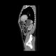 Stomach tumour: CT - Computed tomography