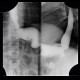 Gastroplication, bariatric surgery of stomach: RF - Fluoroscopy