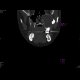 Gorlin Goltz Syndrom: CT - Computed tomography