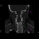 Gorlin Goltz Syndrom: CT - Computed tomography