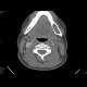 Gorlin Goltz Syndrom: CT - Computed tomography