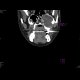 Gorlin Goltz Syndrom: CT - Computed tomography