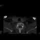 Gorlin Goltz Syndrom: CT - Computed tomography