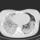 H1N1, atypical pneumonia: CT - Computed tomography