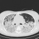 H1N1, atypical pneumonia: CT - Computed tomography