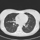 H1N1, atypical pneumonia, follow-up: CT - Computed tomography