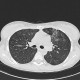H1N1, atypical pneumonia, follow-up: CT - Computed tomography
