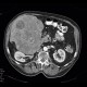 Hepatocellular carcinoma, HCC: CT - Computed tomography
