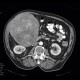 Hepatocellular carcinoma, HCC: CT - Computed tomography