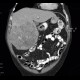 Hepatocellular carcinoma, HCC: CT - Computed tomography