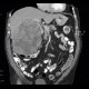 Hepatocellular carcinoma, HCC: CT - Computed tomography